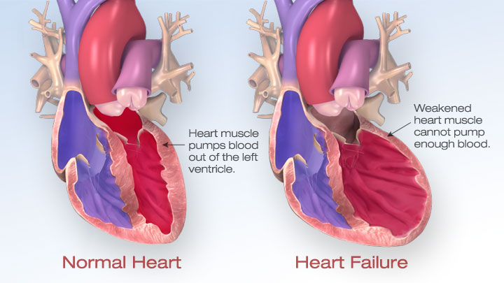 normal heart & heart failure